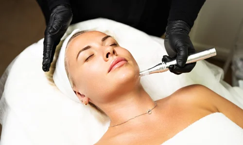 Microagulhamento para estimular a produção de colágeno e melhorar a textura da pele.